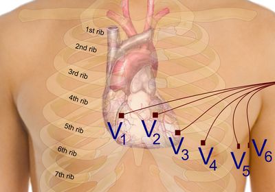 ECG elektrode plaatsing